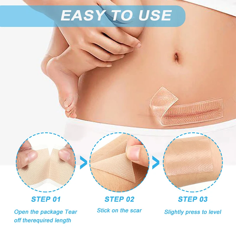 실리콘 흉터 패치 4cmx1.5M 피부 재생 시트 제거 자가 접착 스트레치 마크 테이프 치료 패치 화상 여드름 흉터 피부 관리 ﻿