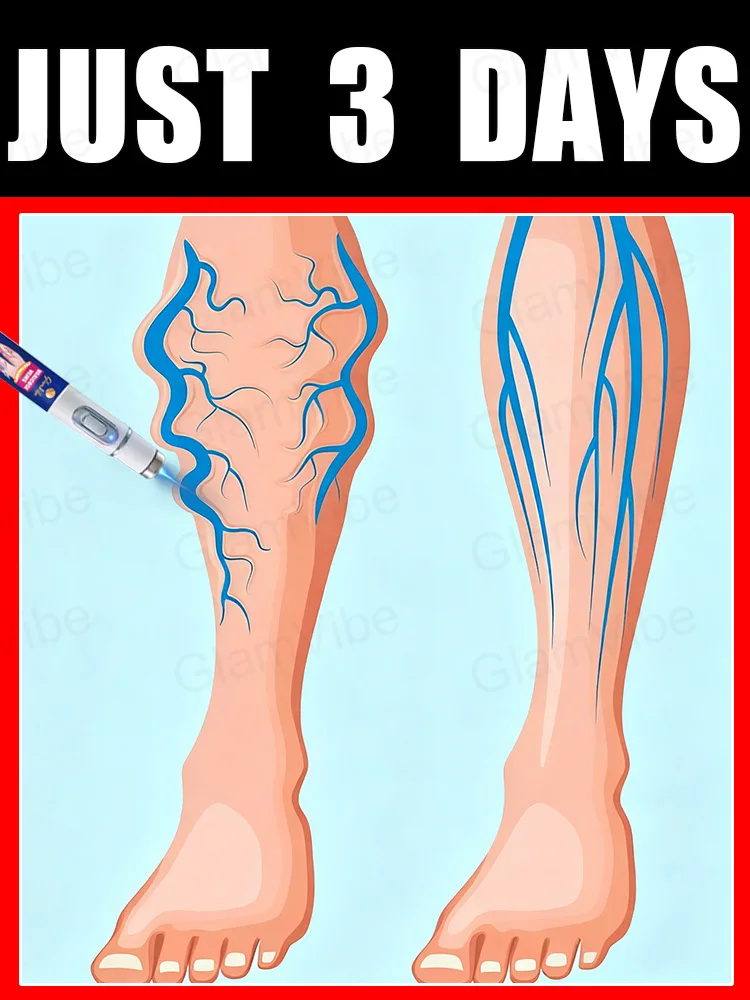 

blue light pen solve varicose veins, hot sale leg care tools