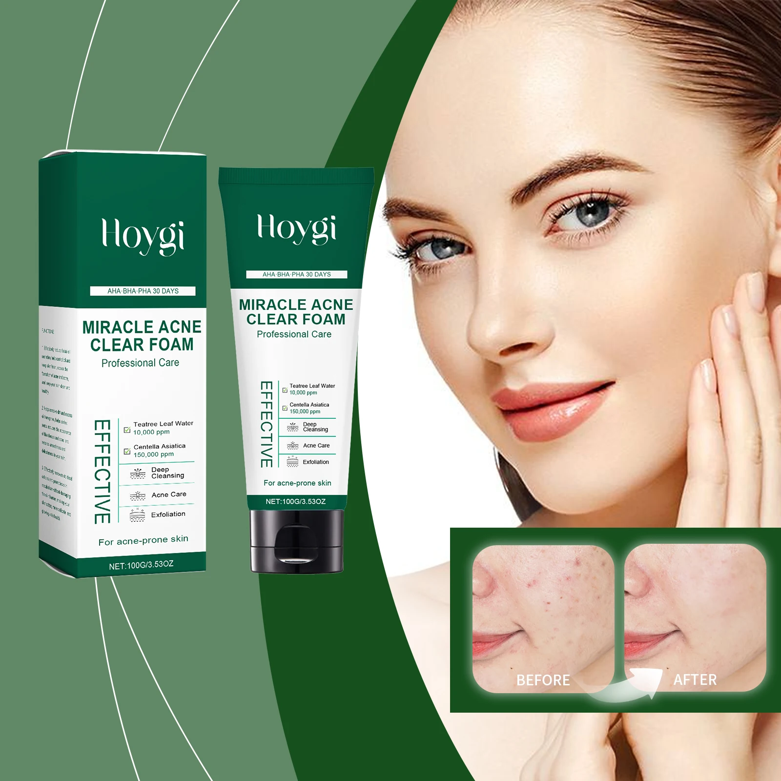 Hoygi Tea Tree Acne Cleanser Daily Oil Control Gentle Pore-Clearing Skin Moisturizing Acne Cleanser Effective Pore Contraction