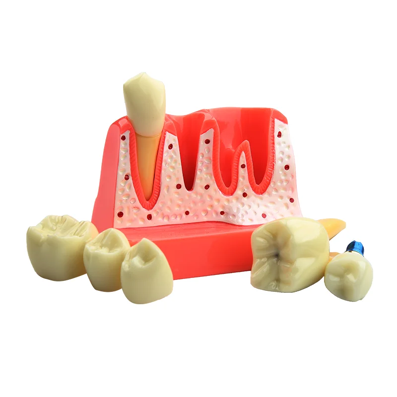 Dental Model Dental Implant Model Denture Bridge Crown Porcelain Restoration Model Dentist Teaching Demonstration Models