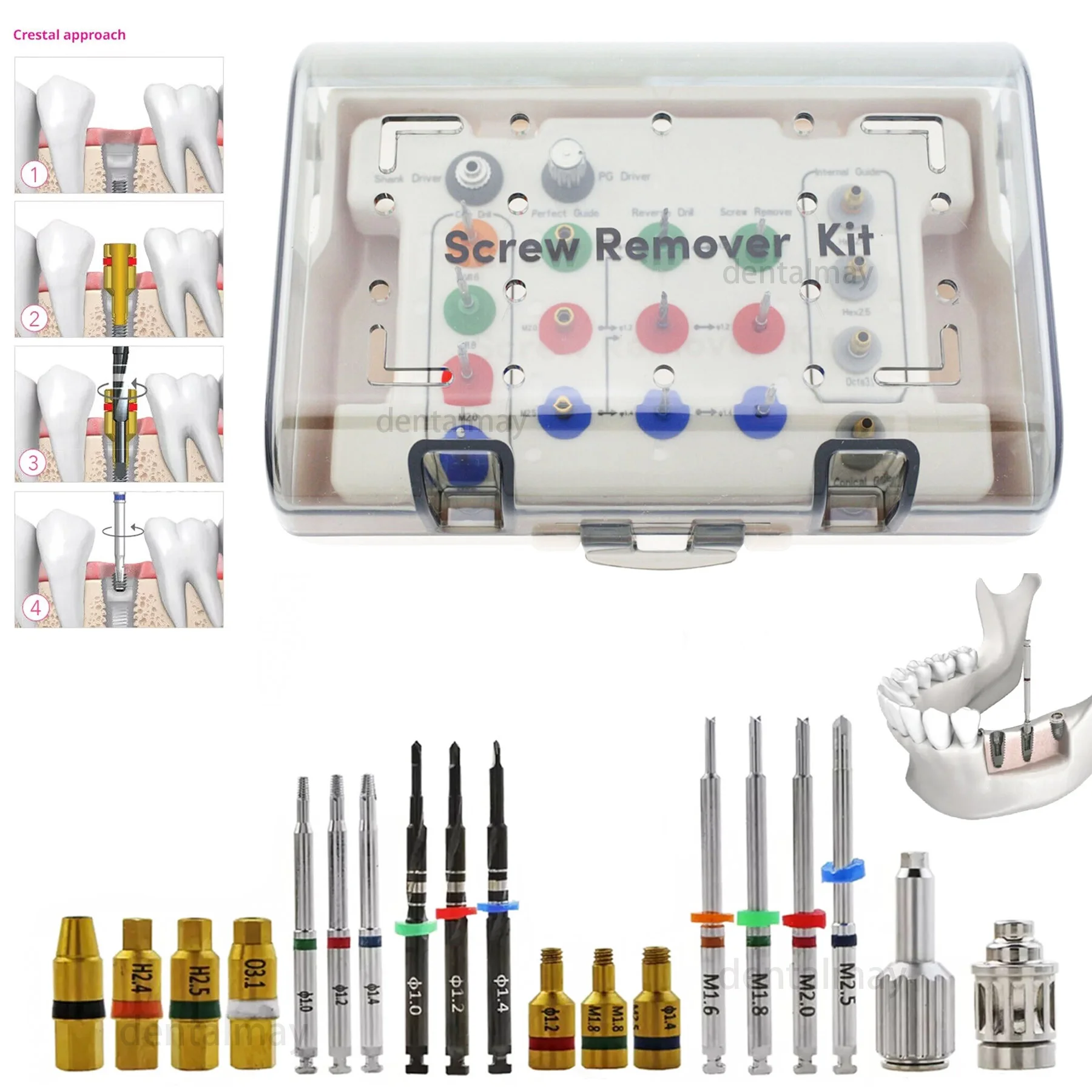 

Dental Broken Screw Remover Kit Surgical Tool NeoBiotech SR Instrument SR Driver Holder