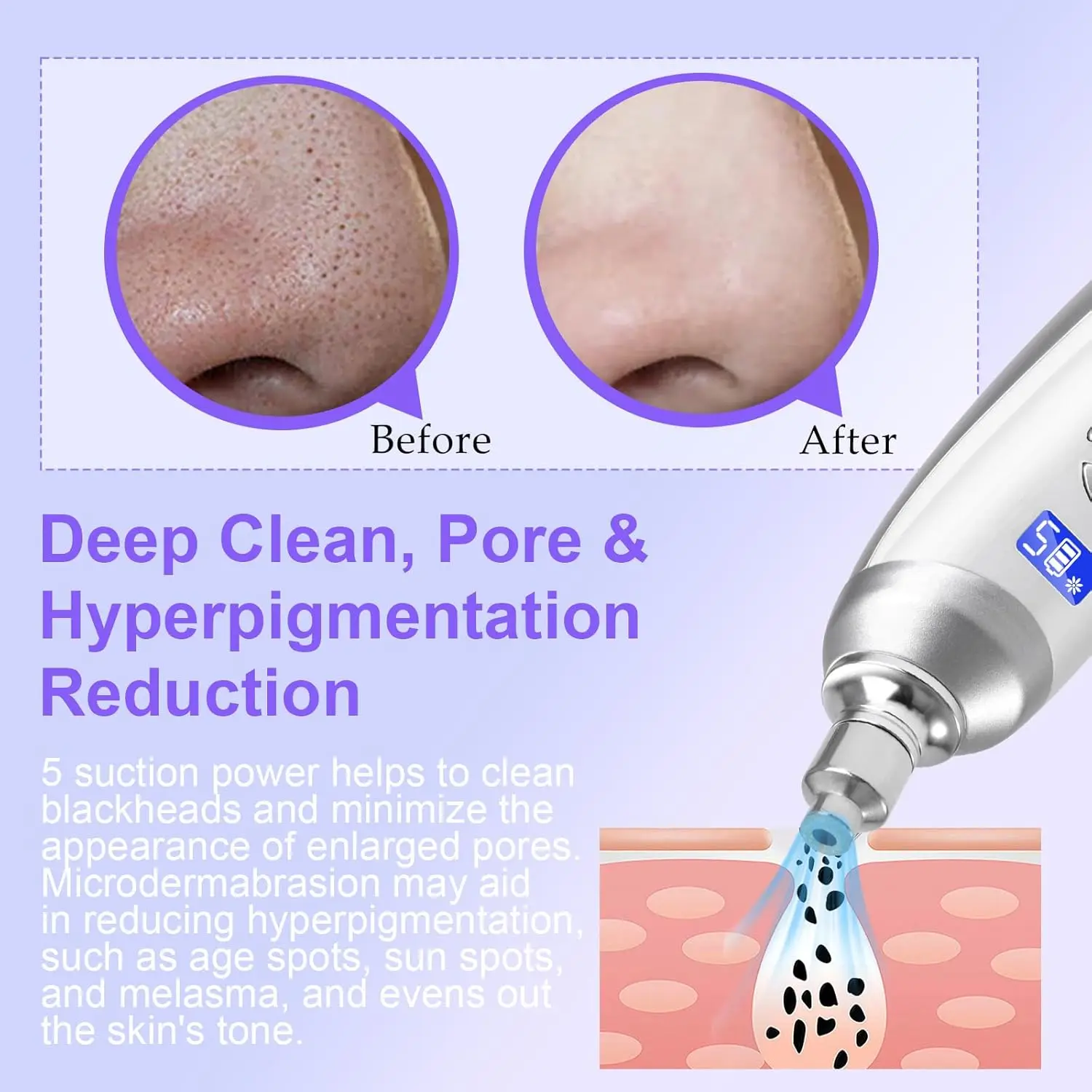 Facial Microdermabrasion Diamond Dermabrasion Machine สําหรับขัดผิว Blackhead Removal,Salon Home ใช้ Microderm อุปกรณ์