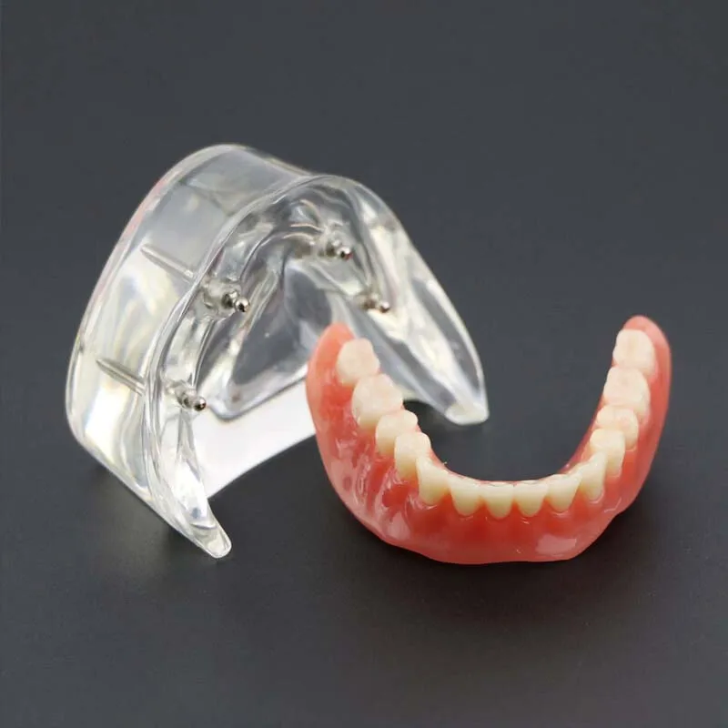 Model zębów dentystyczny z modelem Overdenture z implantem gorszy Model zębów demonstracyjny do badania dentysty Model nauczania stomatologiczne 2/4