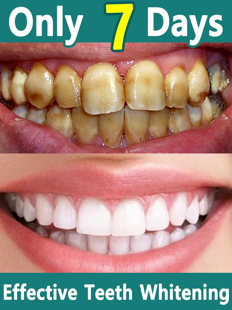 Teeth Whitening Tartar Removal