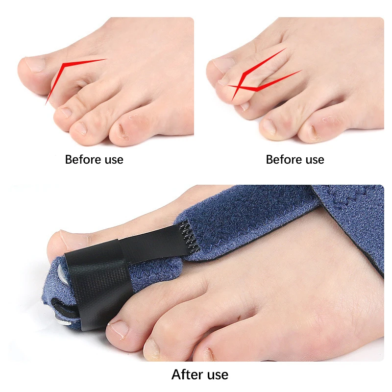 Corretor de dedo do pé, fixador de fratura, ortopédicos, osso do pé, ajustador de polegar, correção macia, meias de pedicure, alisador de joanete