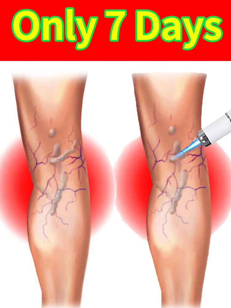 

Eliminates varicose veins and relieves dilated vasculitis in the legs suitable for all age