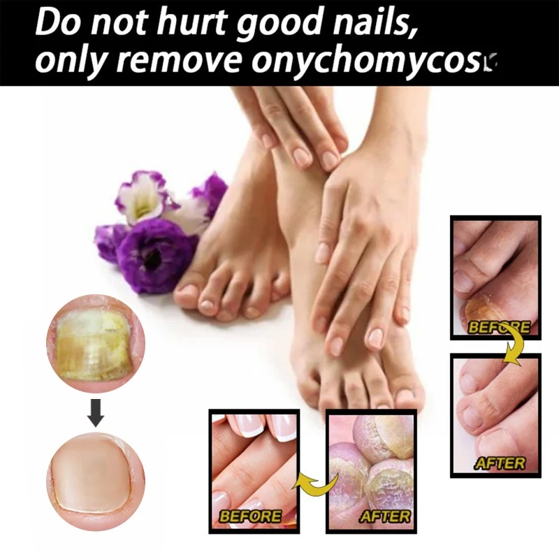 Nail Repair Solution Thickening Bright Nails Remove Onychomycosis Dead Skin Toe Nails Fungus Treatment Moisturizing foot Essence