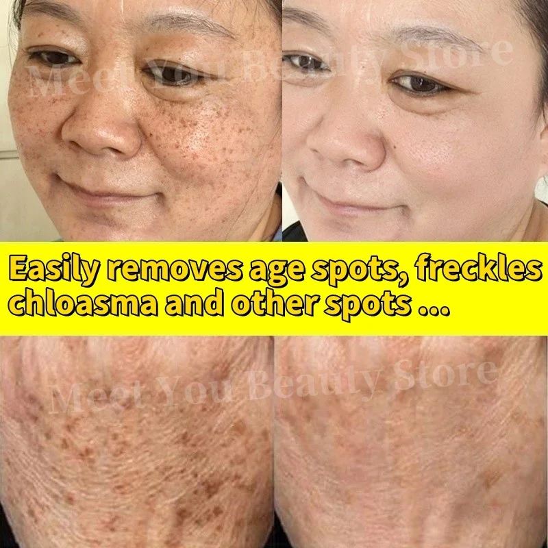 Astragalus clareamento sardas creme eficaz iluminar a pele remover manchas escuras melasma desvanece melanina cicatrizes de acne anti-envelhecimento cuidados com a pele