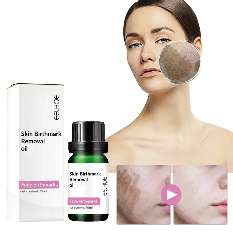 Skin Birthmark removal Serum Anti Freckle fade Pigmentation Melasma Moisturizing Whitening Brighten Face  Care Essence Oil