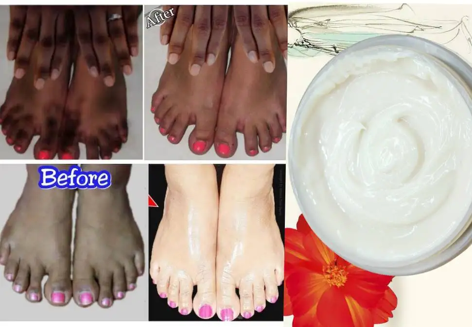 

Intense Brightening Feet Cream, Dark Spots Remover, Beautiful Feet Dark Knuckles Dark Knees Dark Feet Remover Cream