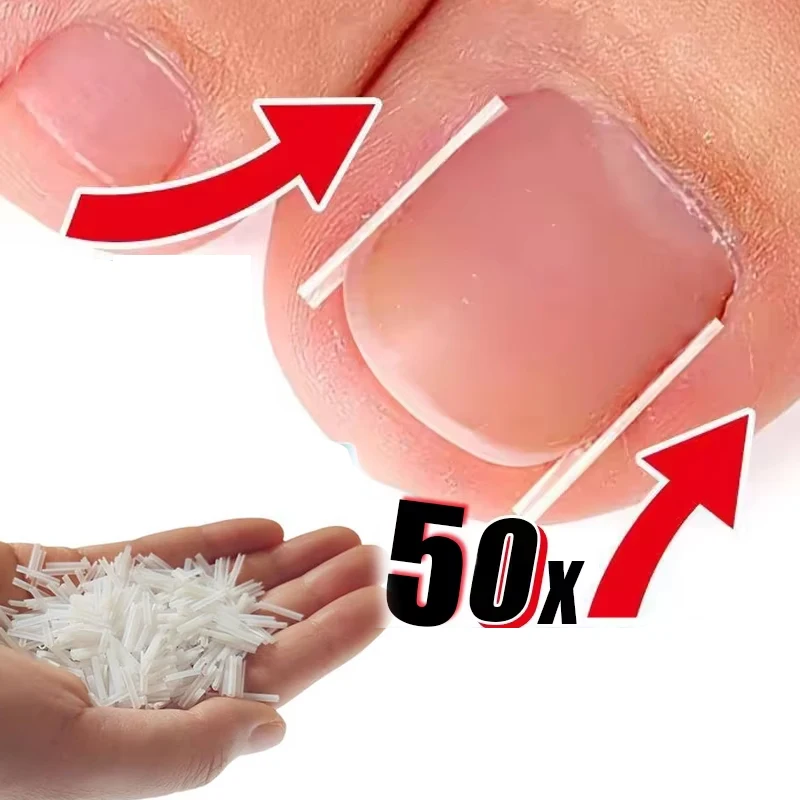 Ingrown Toenail Correction Tool Ingrown Toe Nail Treatment Elastic Patch Sticker Straightening Clip Brace Pedicure Tool