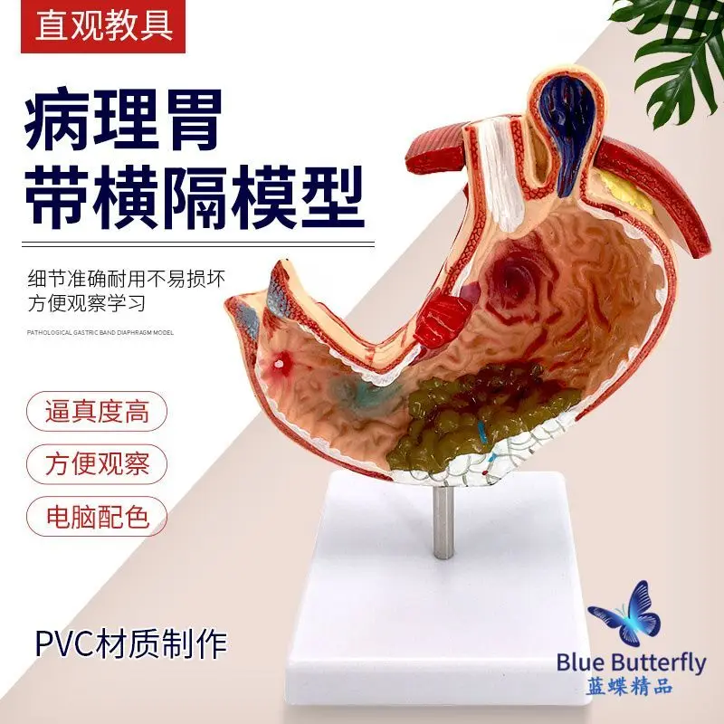 

Demonstration of pathological gastric ulcer/ulcer in gastric model with transverse septum