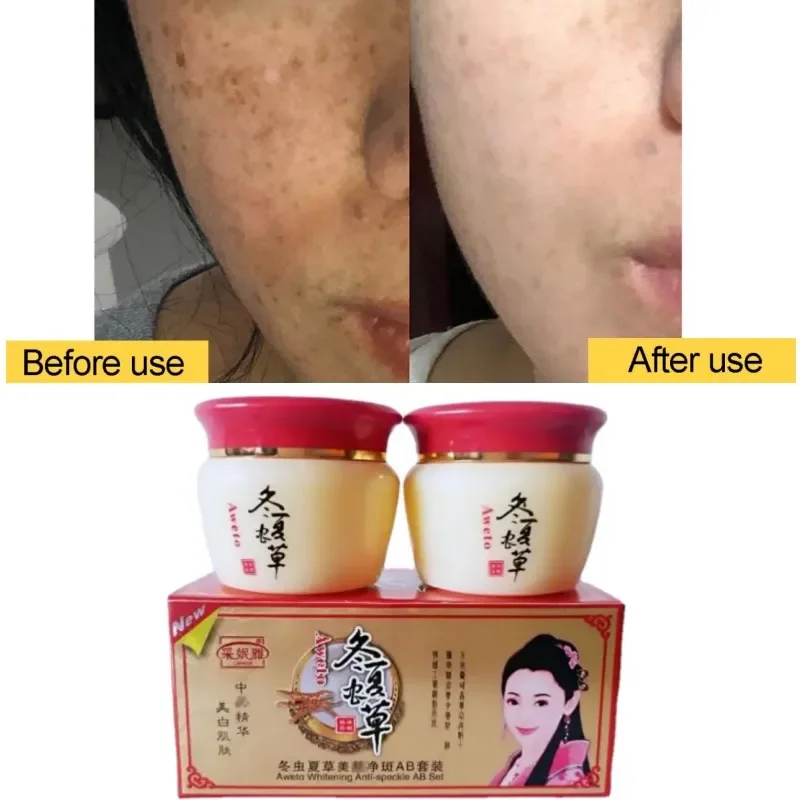 

Herbal Whitening Anti-Acne Day Night Cream Set Melasma Dark Age Dark Spots Freckle Remover Skin Lightening Skin Care