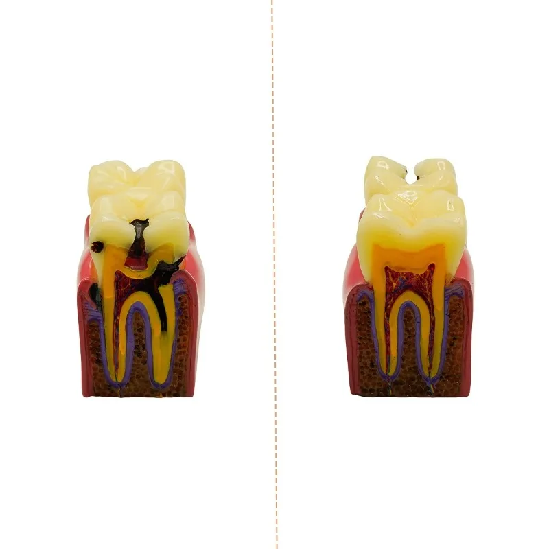 Lab 6 Times Caries Comparsion Tooth Models Study Models for Lab Studying Teaching Anatomy Practice Lab Model s