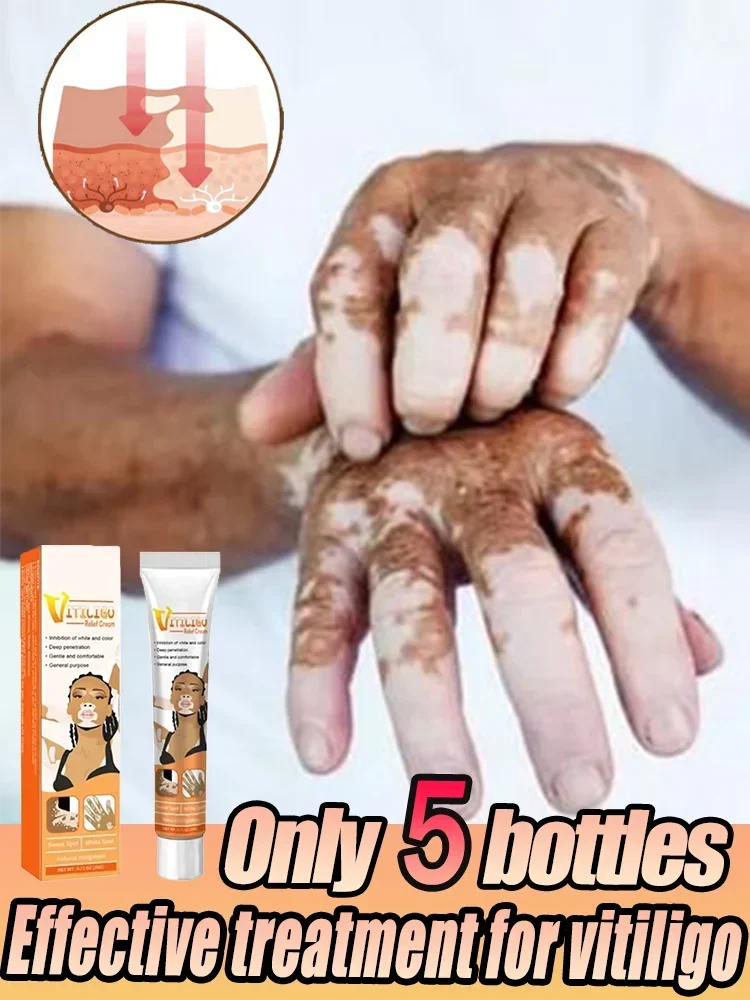 ⁿⁱᶜᵉ Vitiligo Removal Cream Vitiligo Cleansing Facial Care Skin cream Reduces White Spots on Skin even skin tone