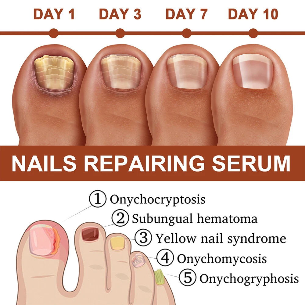 Nail Fungus Treatment Serum Toe Fungal Repair Products Hand Foot Care Removal Gel Anti Infection Onychomycosis Paronychia