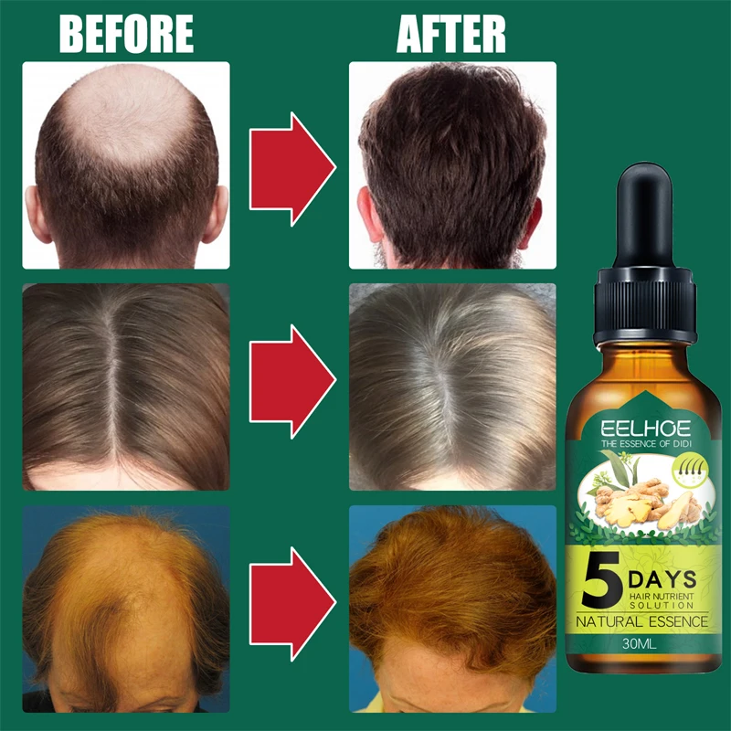 Natural Ginger Hair Growth Products, Anti Hair Loss, Prevenir a calvície, tratamento, crescimento rápido, nutrido, seco, danificado Hair Care, 5 dias