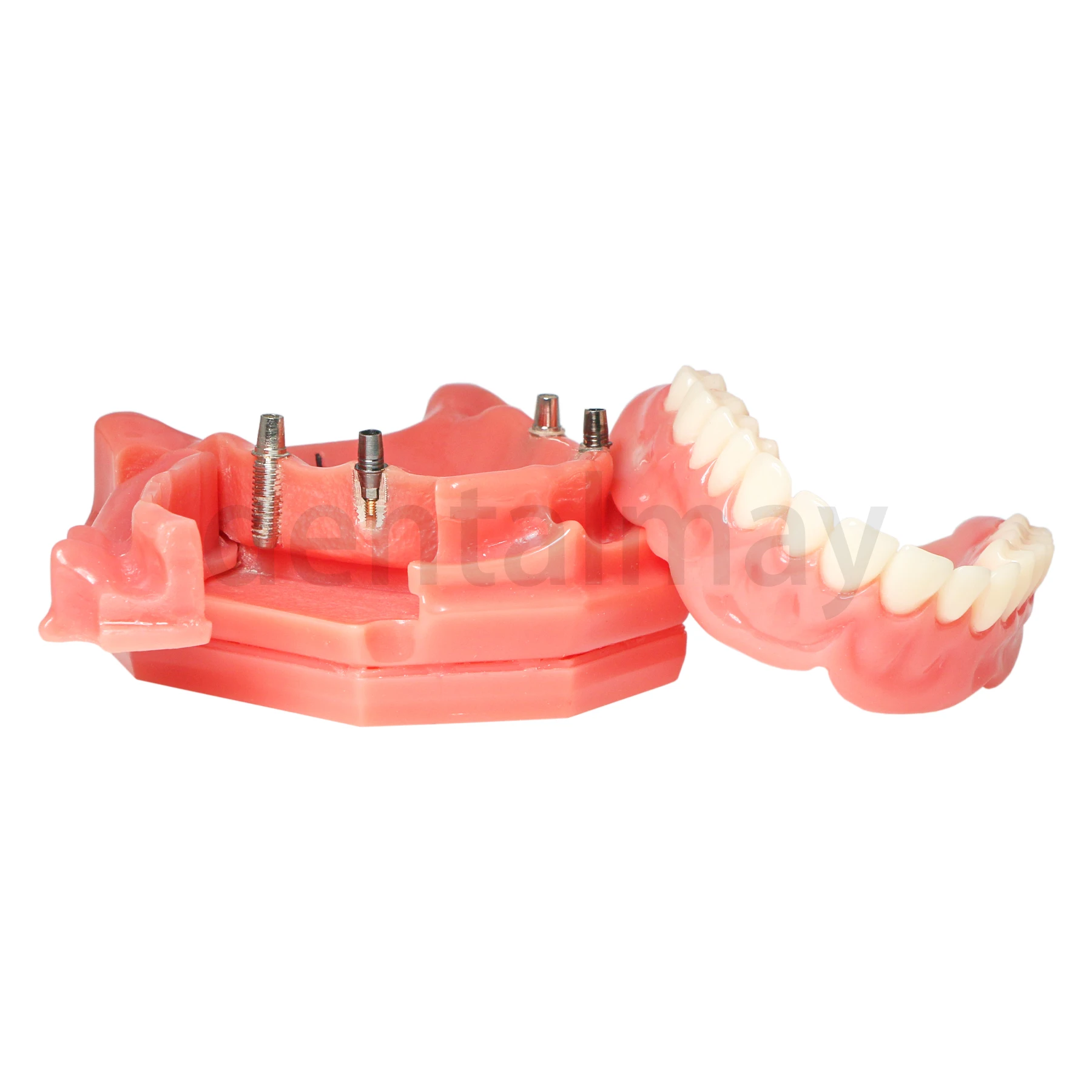 Dental Implant Teeth Model Overdenture Model Demonstration Semi-Oral Movable with Partial Denture Demo 2 Implants M6001-A