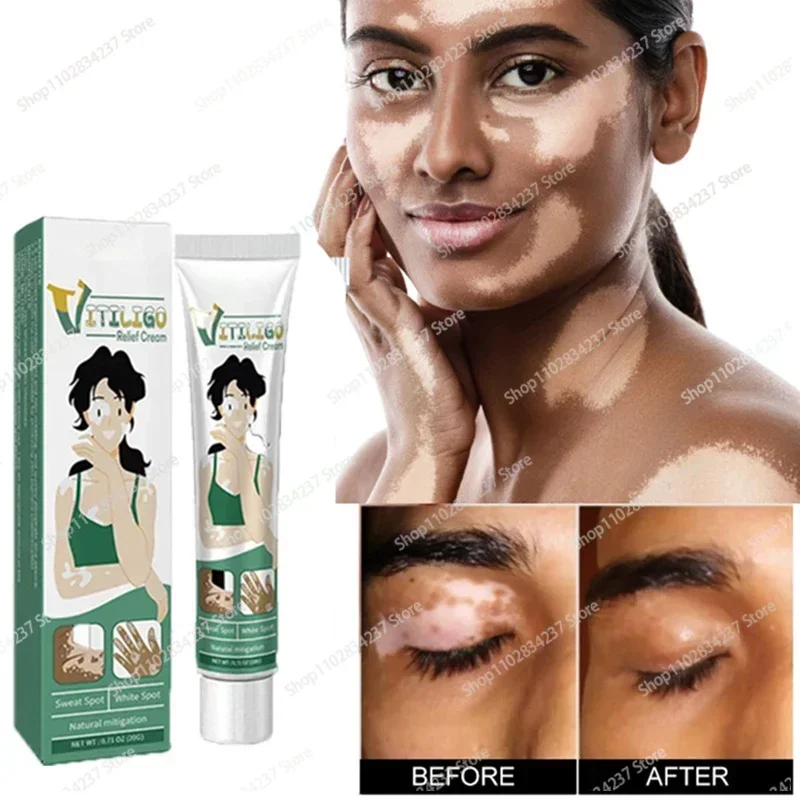 Improve Skin Pigmentation and Reduce White Spots Vitiligo 0924