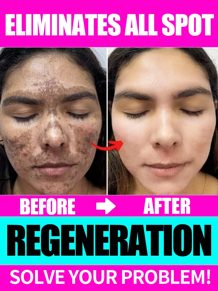 

Freckles Cream Dark Spot