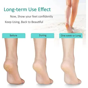 Taş tüy dökücü için en iyi 5 satış-no. 4