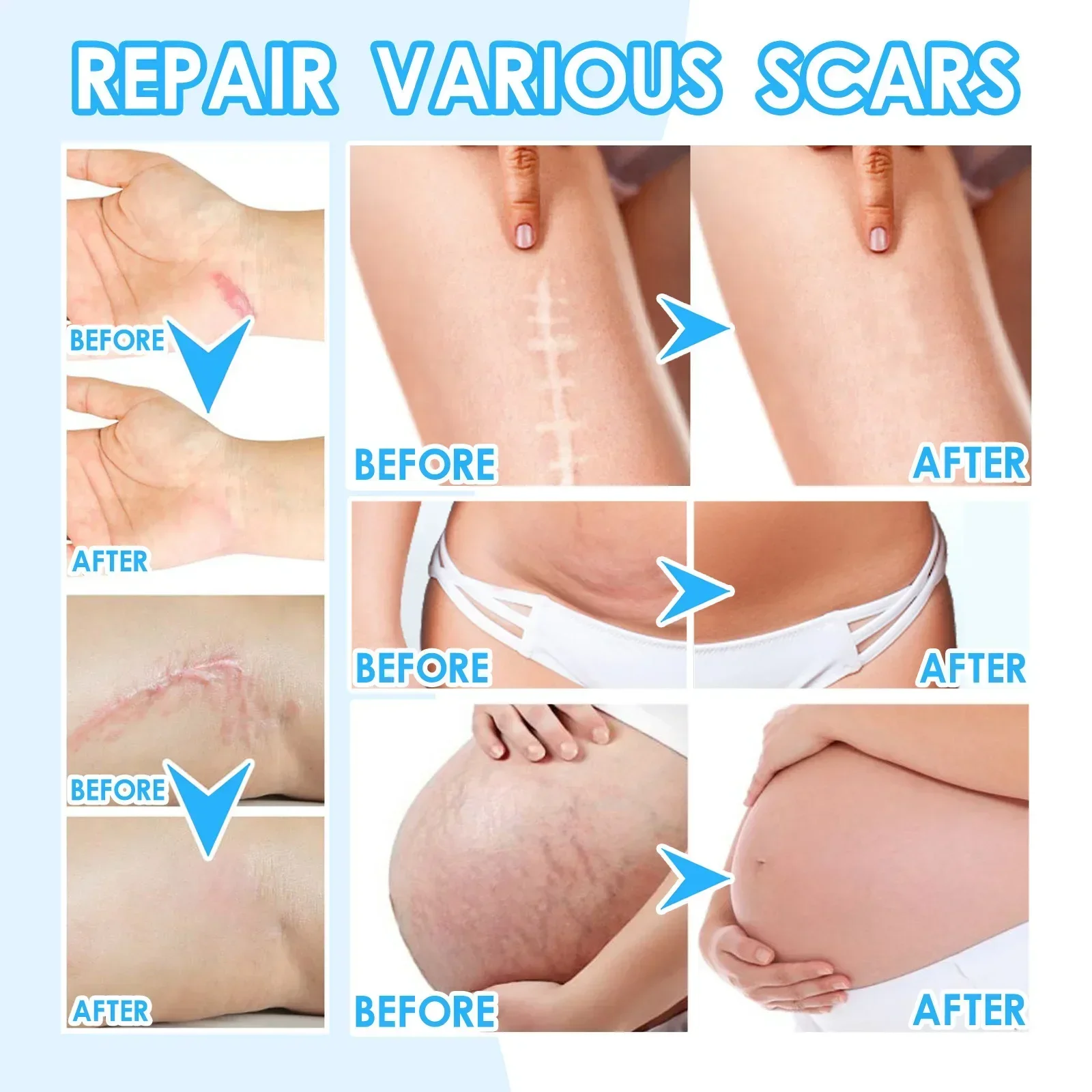 Scar cream gel effective repair surgical scars stretch marks acne pits pockmarks burn scars repair treatment