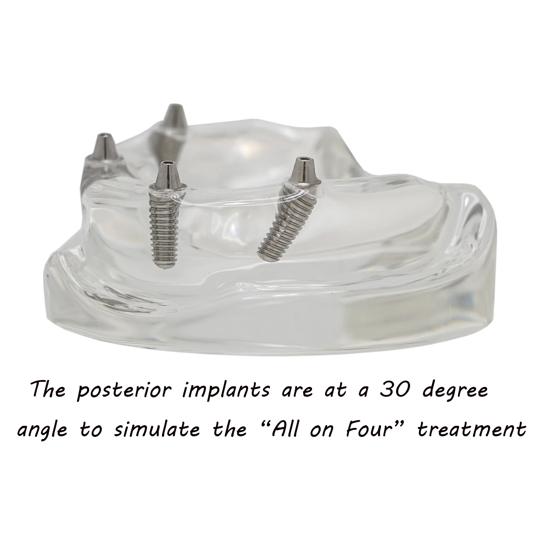 Implant Teeth Model 4 Removable Screws All on 4 Transparent Upper Jaw Type Overdenture Modle