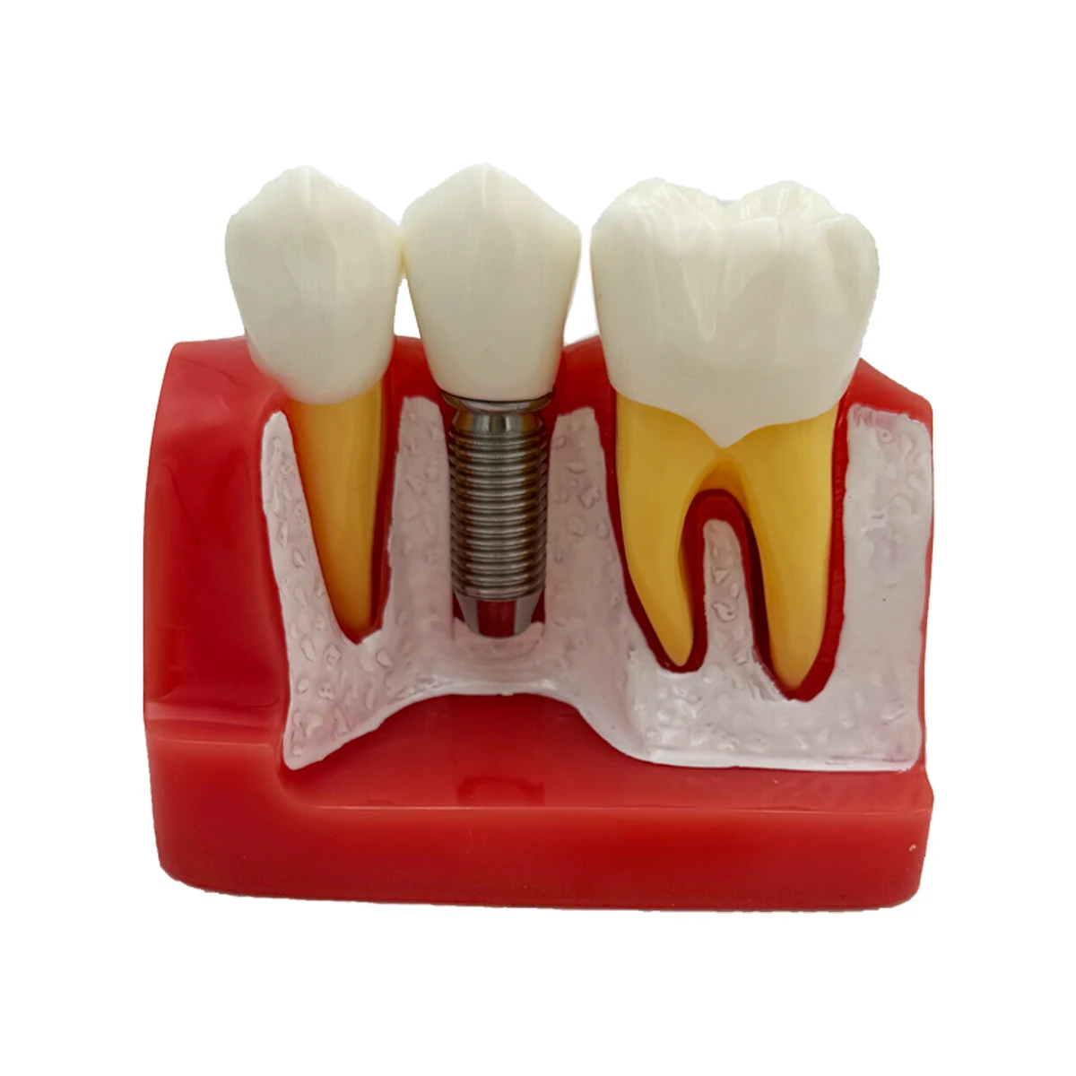 Dental 4 Times Implant Teeth Model Removable Analysis Crown Dentistry Demonstration Model Implants For Study Training Models