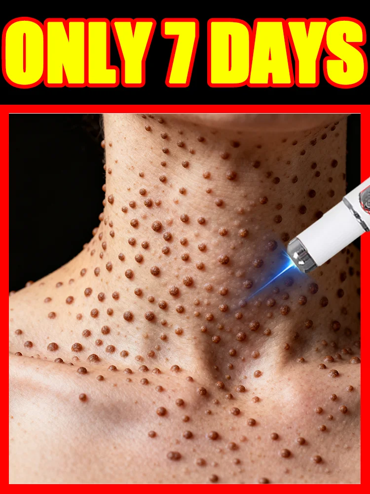 

Today's Deal,free shipping,blue light pen solve warts,wart care tools,Bestselling