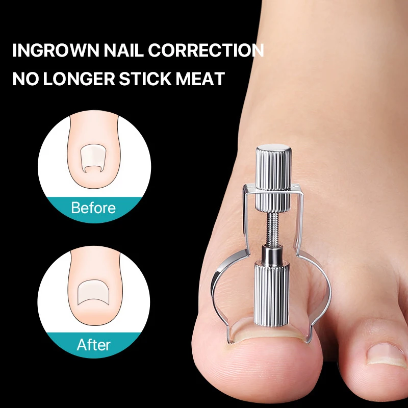 Ingrown Toenail Corrector Straightening Clip Pedicure Foot Nail Care Tools Stainless Steel Pedicure Treatment Onyxis Correction