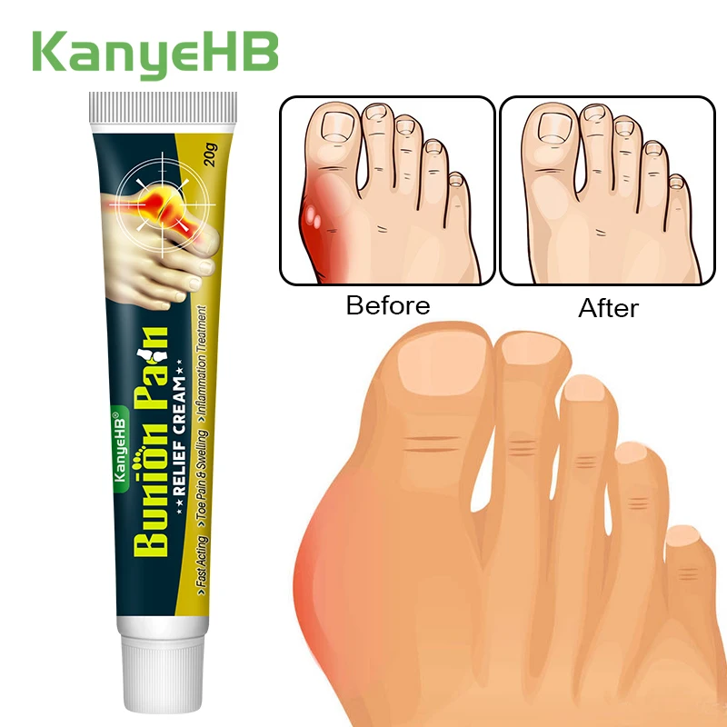 1Pcs Foot Gout Cream Arthritis Bone Thumb Corrector Finger Hallux Toe Bunion Joint Pain Relief Herbal Medical Care Ointment G049