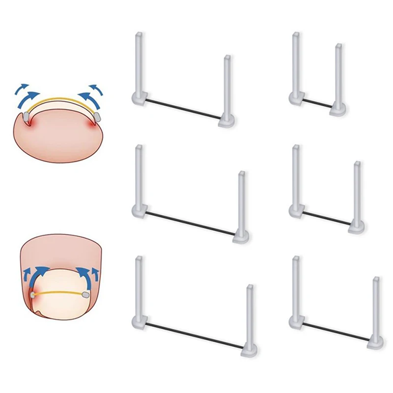 Alambre de corrección de uñas encarnadas, herramientas para el cuidado de los pies, tratamiento profesional, recuperación, incrustado, pedicura, alisado de dedos de los pies