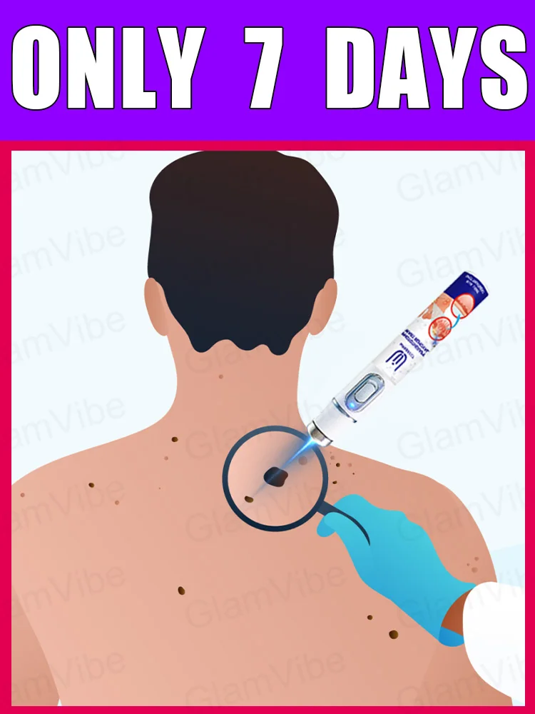 

blue light pen solve warts, hot sale wart care tools