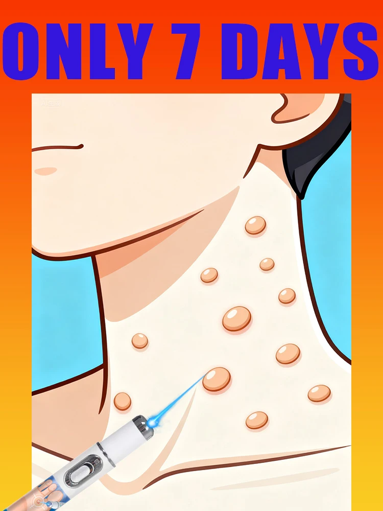 

Лазерная ручка с синим лучом для удаления кожных новообразований, инструменты для ухода за кожей и гладкости.