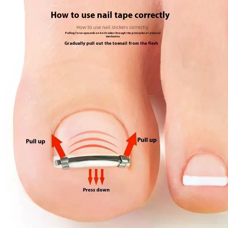 陥入爪矯正クリップ プロ仕様の湾曲したクランプ ペディキュアツール 陥入爪ケア＆埋没爪矯正用