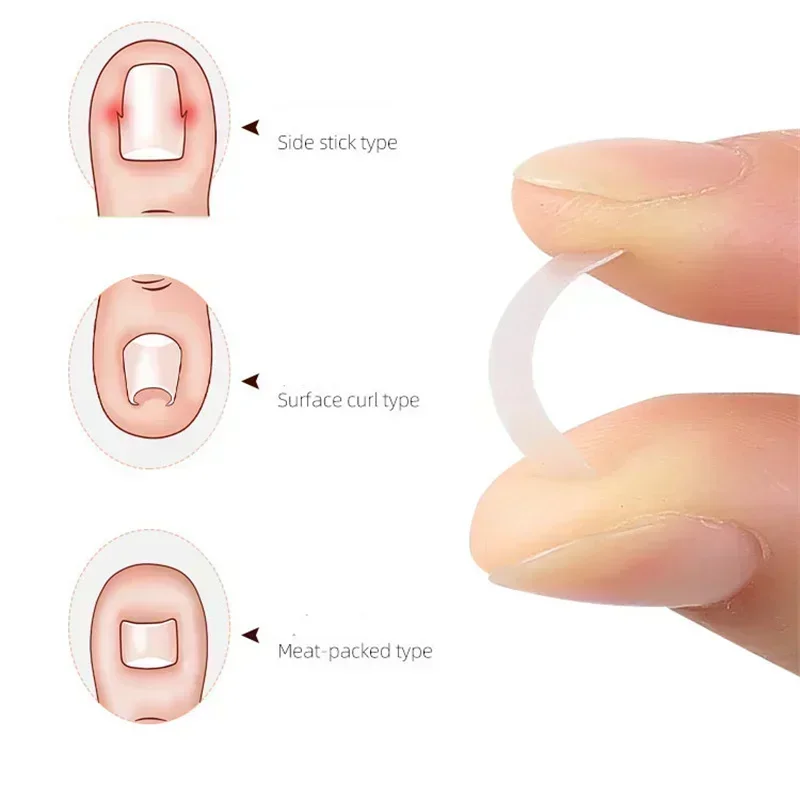 เล็บร่องคุด Toenail Correction อุปกรณ์เล็บ Patch Pull-Up เล็บเท้า Pedicure ชุด Quick ติดแถบ