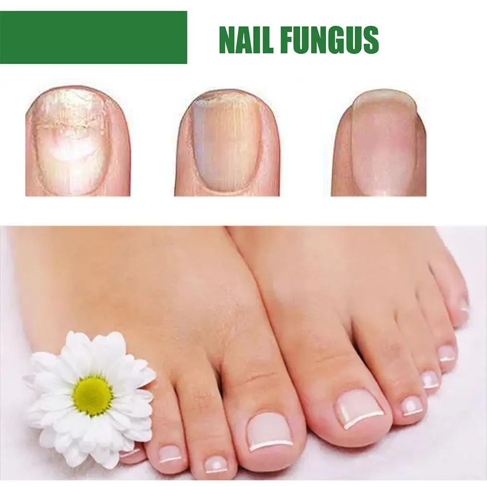 Fungal Nail Treatment Essence Oil เชื้อราเล็บเลเซอร์อุปกรณ์ซ่อมเล็บเท้าเล็บขิง Treatment มือเท้า Essence Liquid