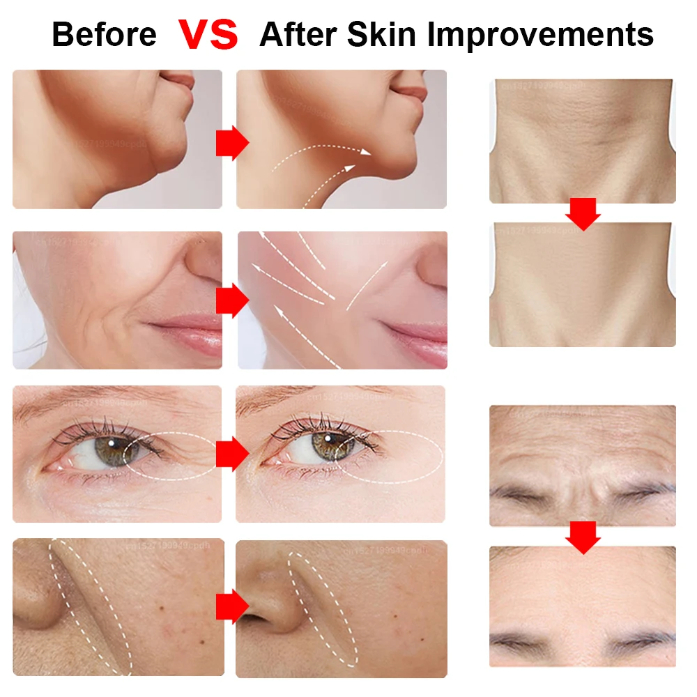 Mini Facial Lifting Machine Microstroom Huidverjonging Radiofrequentie Huid Lifting Machine Verwijder Rimpel Huidverzorging Apparaat