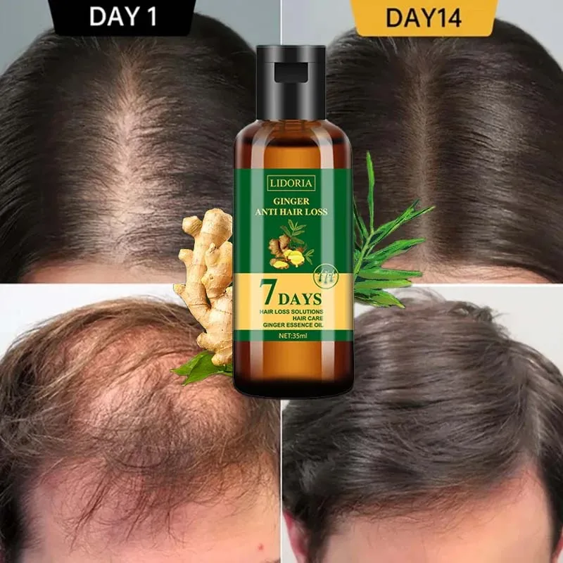 Ginger Hair Growth Essential Oil Anti-loss Hair Regrowth Serum Fast Growth Prevent Baldness Treatment Alopecia Hair Health Care