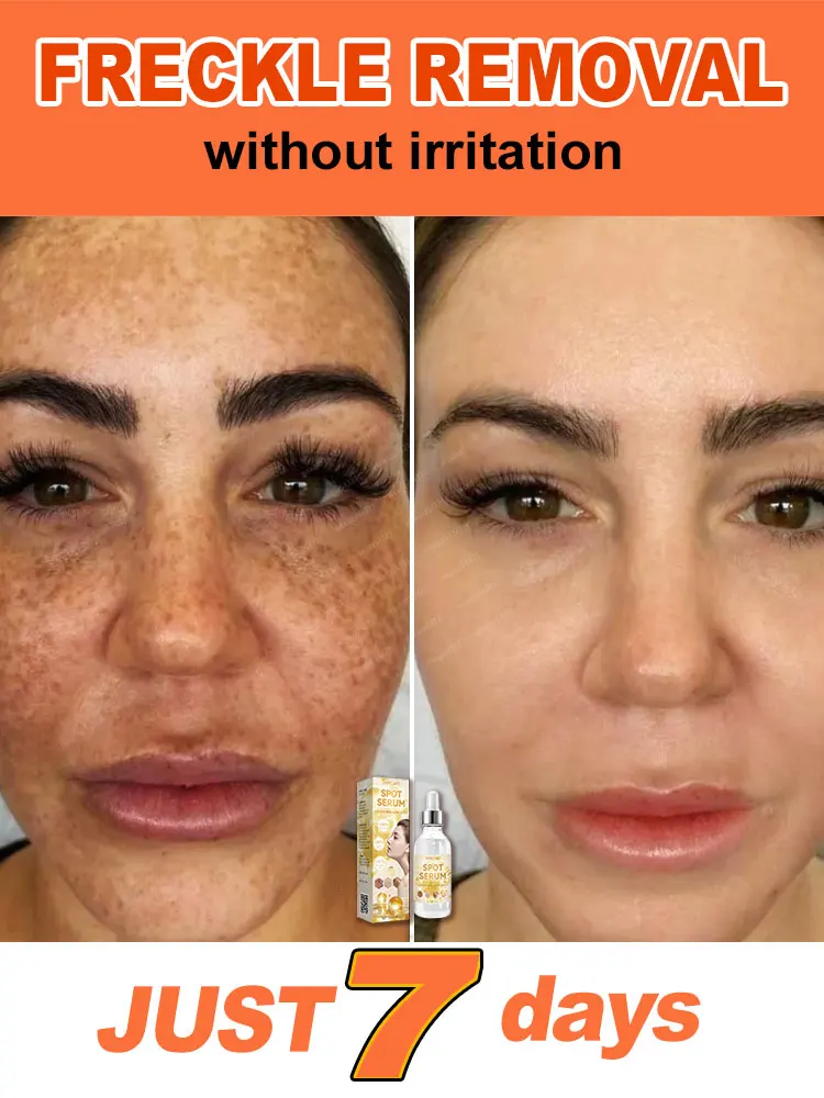 

Remove spots, whiten, restore white skin