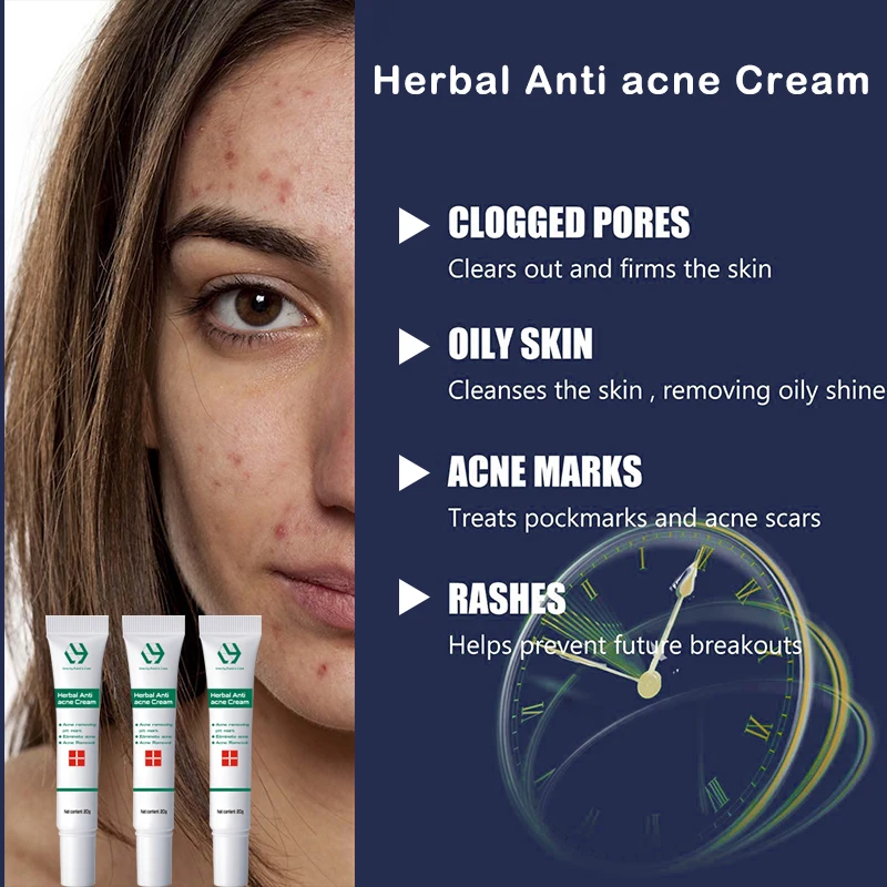 Acne Removal Whitening Cream Effective Fade Acne Spots Repair Gel Oil Control Moisturizing Shrink Pores Acne Treatment Skin Care