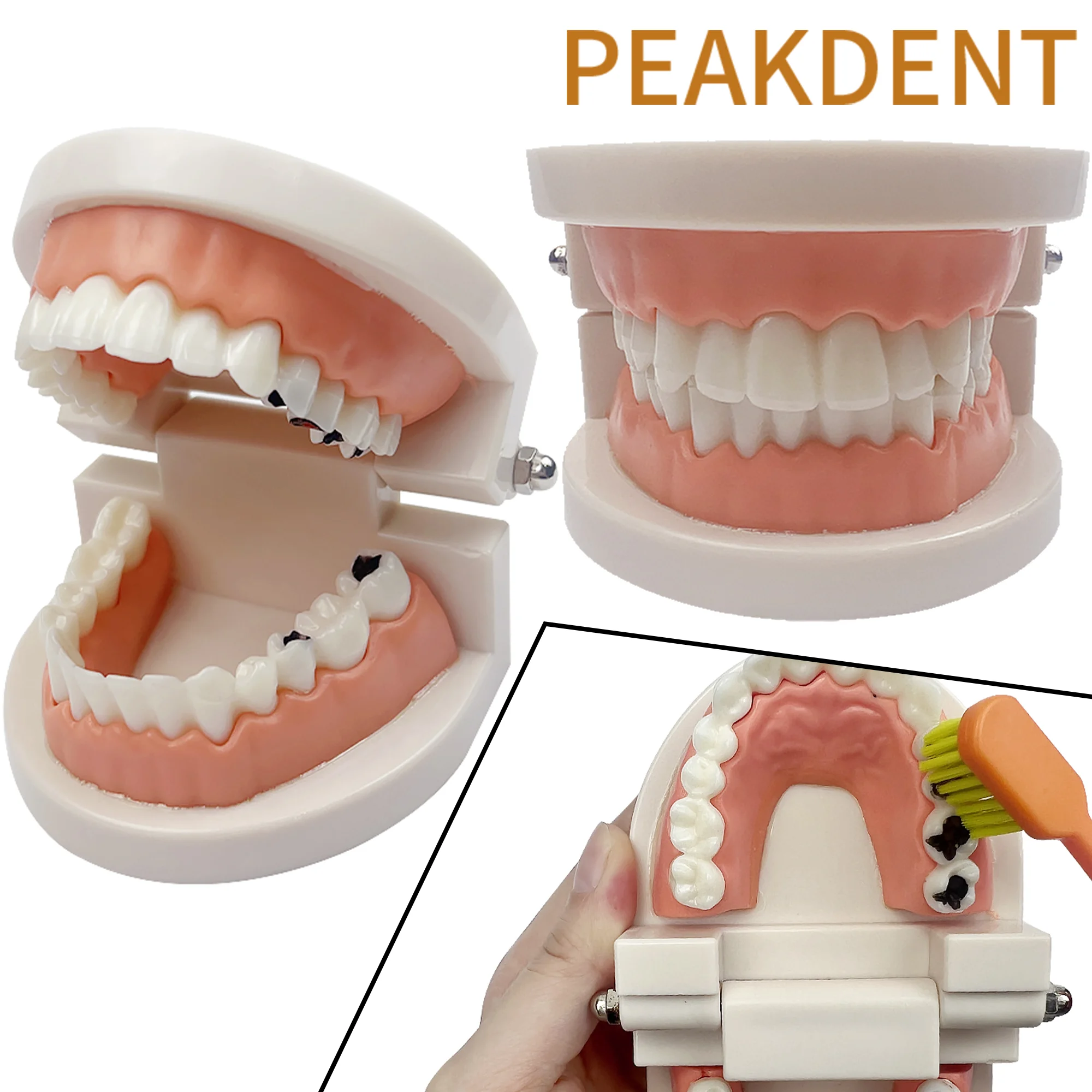 Dental Model Brushing Teeth Education Model Caries Tooth Care Dental Anatomy Education Teeth Periodontal Disease Model