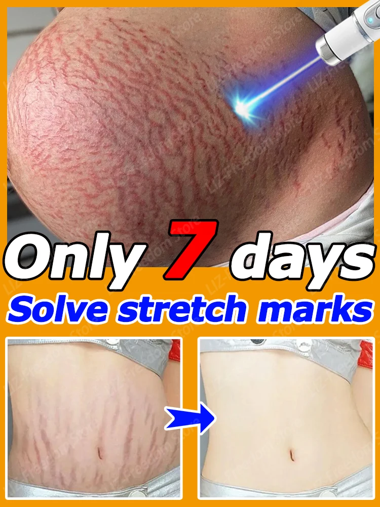 

Stretch Mark Cream Reduces Scar Lncrease Skin Elasticity Smoothes Firms Hydrates Nourishes