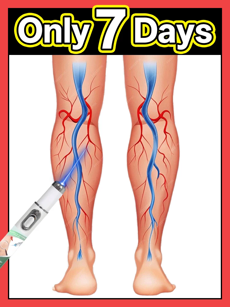 

Stylo à lumière bleue pour résoudre les varices, outils de soins des jambes, offre spéciale