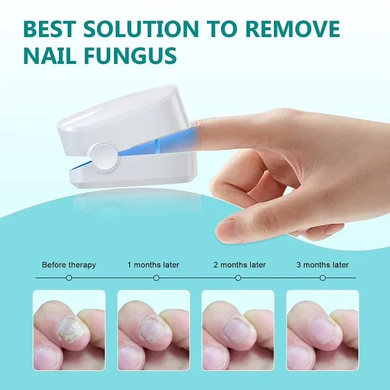 

Nail Fungus Laser Treatment Device For Toenail Fingernail Fungus Treatment Extra Strength Treat OnychomycosisToe Nail Fungus