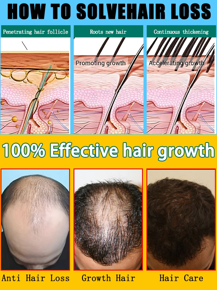 De haargroeiproducten kunnen de hoofdhuid penetreren, wees gerapporteert de haargroei en herstelt het verloren haar