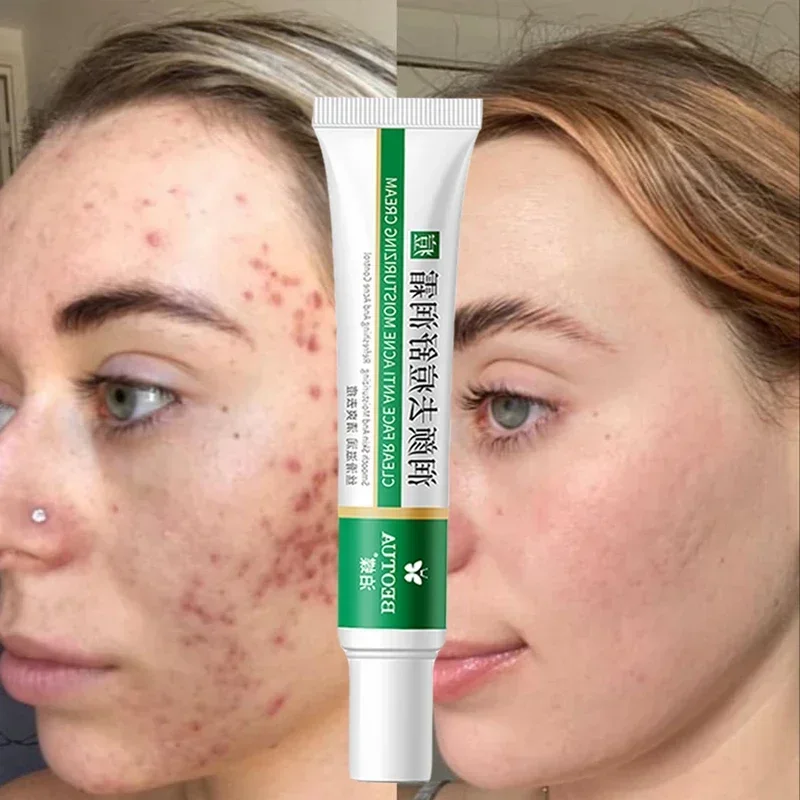 Effective Acne Removal Cream Aloe Acne Spots Oil Control Anti-aging Moisturizing Whitening Acne Cream Treatment Skin Care 20g