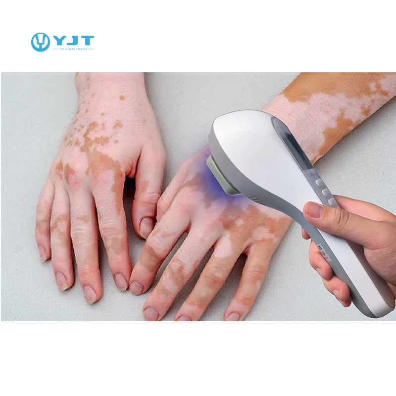 Portable Handheld 308nm LED UVB Phototherapy Vitiligo Treatment Phototherapy for Skin Diseases Treatment