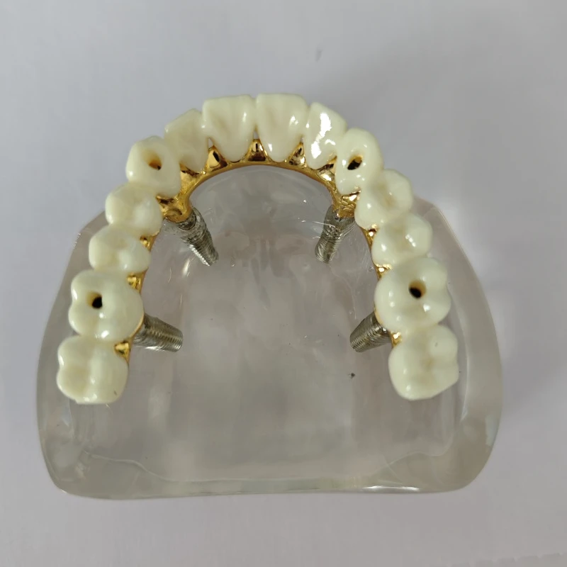 1pc Dental Implant Bridge Model Overdenture Restoration Upper Jaw Removable Teeth Model Dentisit Oral Teaching Research Tools