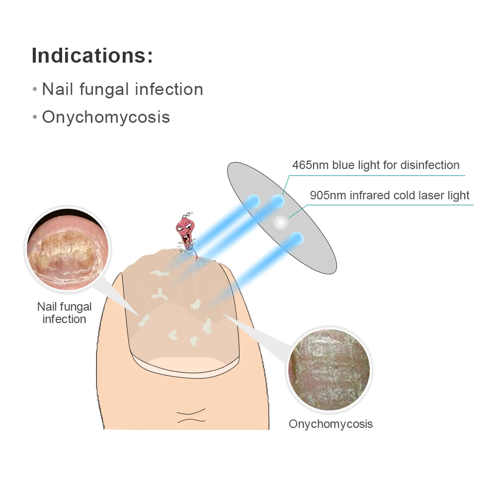 Neues Erfindung produkt 905nm Laser Zehen nagel Nagel pilz Behandlungs maschine